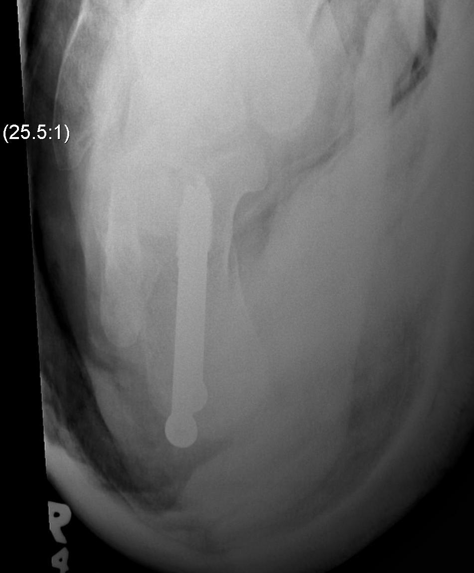 Calcaneal Sliding Osteotomy Harris Axial